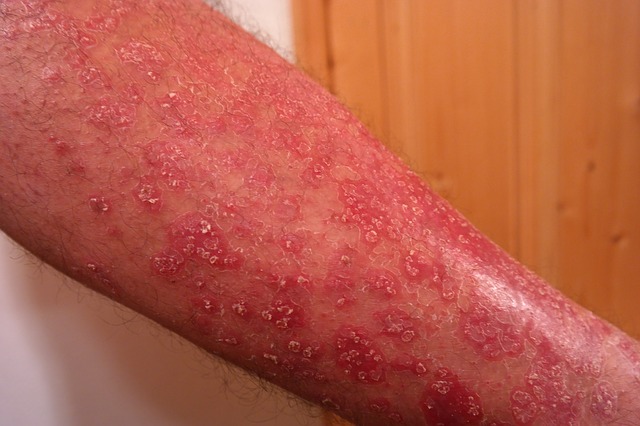 kožní nemoc